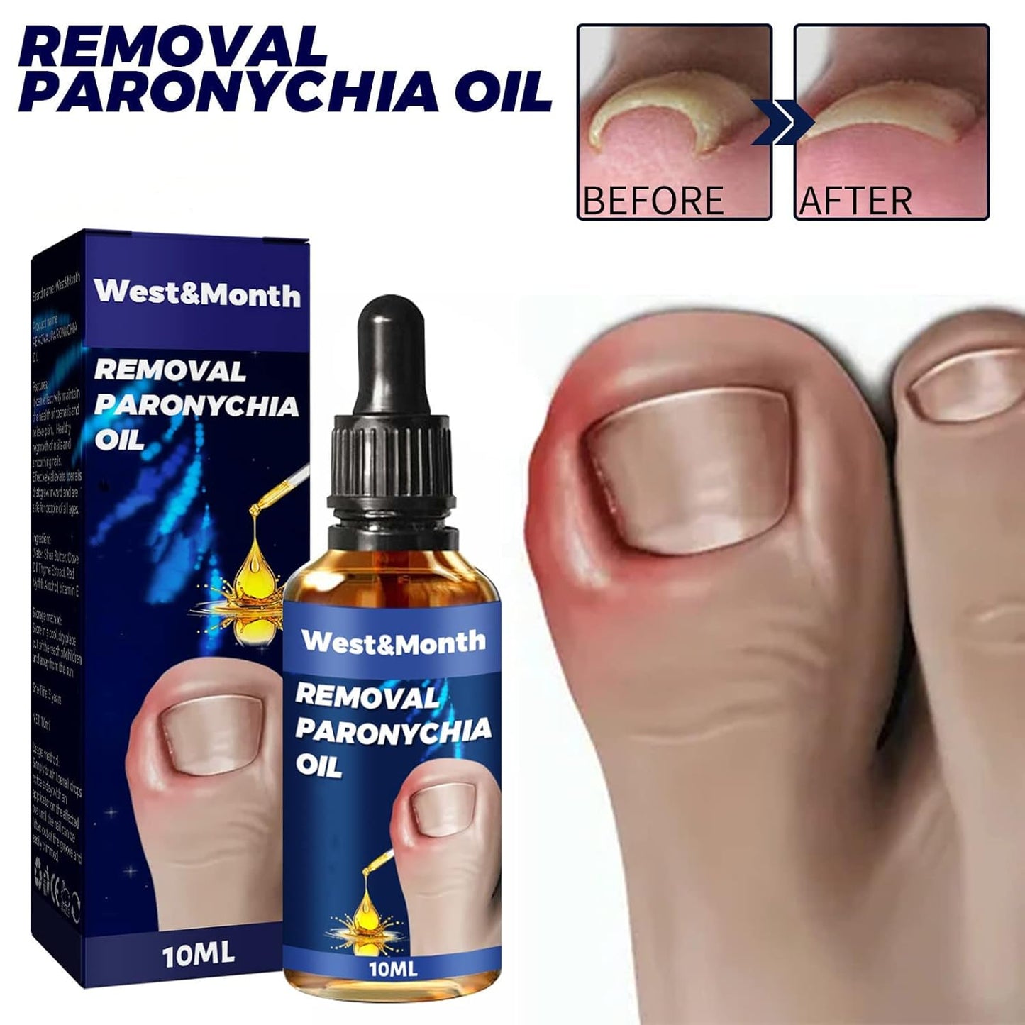 Aceite Reparador Para Uñas Encarnadas